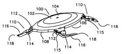 REFRACTIVE INTRAOCULAR IMPLANT LENS AND METHOD