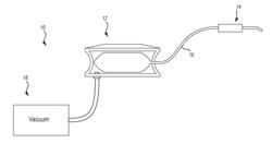 VACUUM ASSISTED IRRIGATION PUMP