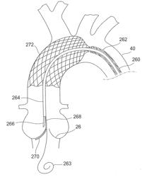 BICUSPID VALVE DISSECTION DEVICE