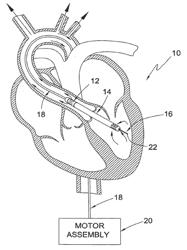 GUIDABLE INTRAVASCULAR BLOOD PUMP AND RELATED METHODS