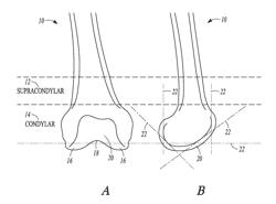 DEVICES AND METHODS OF ACCELERATING BONE CUTS