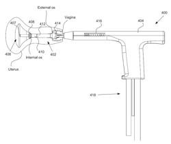 Positioning method and apparatus for delivering vapor to the uterus