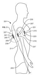 Magnetic fixation apparatus for percutaneous catheter