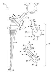 Modular femoral prosthesis system for hip arthroplasty