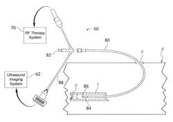 Image Guided Intravascular Therapy Catheter Utilizing a Thin Chip Multiplexor