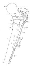 BONE FIXATION WITH A PLATE AND A COUPLER CONNECTED BY FLEXIBLE MEMBERS