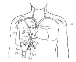 METHODS AND APPARATUS TO DELIVER THERAPEUTIC, NON-ULTRAVIOLET ELECTROMAGNETIC RADIATION VERSATILELY VIA A CATHETER RESIDING IN A BODY CAVITY