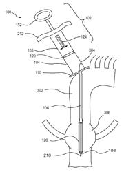 Valve introducers with adjustable deployment mechanism and implantation depth gauge