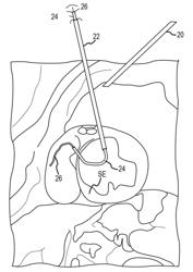 TRANS-CATHETER VENTRICULAR RECONSTRUCTION STRUCTURES, METHODS, AND SYSTEMS FOR TREATMENT OF CONGESTIVE HEART FAILURE AND OTHER CONDITIONS