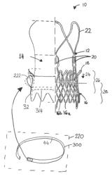 Prosthesis seals and methods for sealing an expandable prosthesis