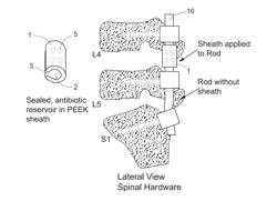 Antibiotic drug release sheath