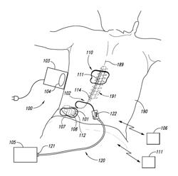 Selective high frequency spinal cord modulation for inhibiting pain, including cephalic and/or total body pain with reduced side effects, and associated systems and methods