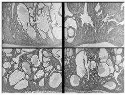 DIET COMPOSITION FOR THE PREVENTION AND/OR THE TREATMENT OF ENDOMETRIAL HYPERPLASIA