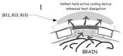 Methods and devices for brain cooling for treatment and/or prevention of epileptic seizures