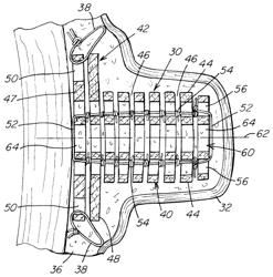 Implantable prosthesis for reconstruction of an anatomical feature