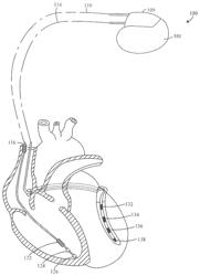 METHOD AND DEVICE FOR DETECTING ATRIAL FIBRILLATION IN THE PRESENCE OF VENTRICULAR PACING