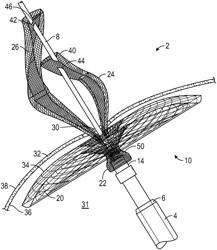 Endo-cameral closure device