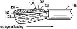 Distal subannular anchoring tab for side-delivered transcatheter valve prosthesis