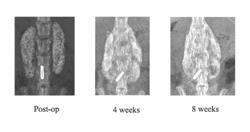 Implants having a high drug load of an oxysterol and methods of use