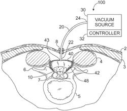 Devices and methods for treating spinal cord tissue