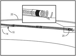 LEADED ELECTRICAL STIMULATION SYSTEM