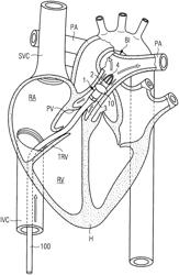 INTRAVASCULAR BLOOD PUMP WITH BALLOON