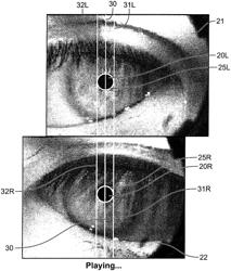 Methods, systems, and devices for monitoring anisocoria and asymmetry of pupillary reaction to stimulus