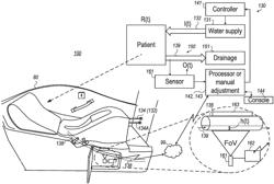 REDUCING UNCOMFORTABLE SIDE EFFECTS OF ABDOMINAL DISTENSION IN PATIENTS TREATED IN HYDROCOLONIC PREPARATION UNITS