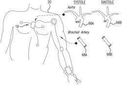 Body-worn system for continuous, noninvasive measurement of cardiac output, stroke volume, cardiac power, and blood pressure