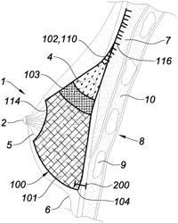 Prosthesis for supporting a breast structure