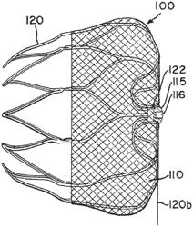 Atrial appendage blood filtration systems