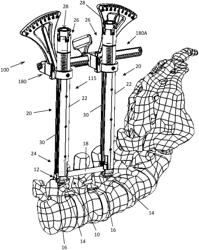 Spinal Alignment Frame