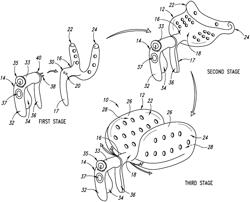 METHOD OF PROTECTING THE PELVIC FLOOR DURING VAGINAL CHILDBIRTH