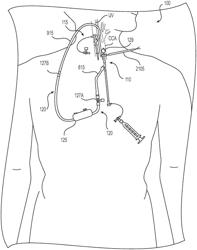 SYSTEMS AND METHODS FOR TREATING EYE DISEASES