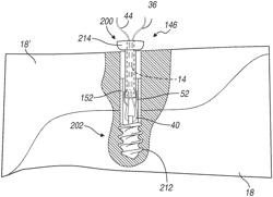 Fracture fixation device