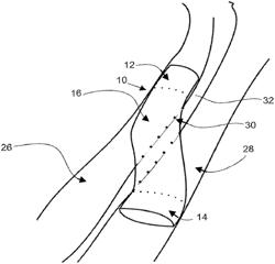 Devices for fluid flow through body passages