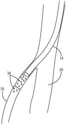 EMBOLIZATION WITH TRANSIENT MATERIALS