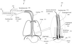 Systems and methods for tracking spontaneous breathing in a mechanically ventilated patient