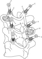 Method and fixture for guided pedicle screw placement