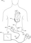 Mobility-Enhancing Blood Pump System