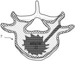 Devices, compositions and methods for bone and tissue augmentation