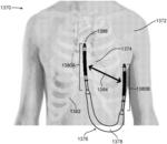 Flexible semi-hermetic implantable medical device (IMD) structure