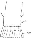 Transcatheter stent-valves