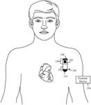 METHOD AND SYSTEM TO DETECT P-WAVES IN CARDIAC ARRHYTHMIC PATTERNS