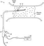 LESION CROSSING SHOCK WAVE CATHETER