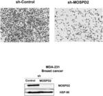 MOTILE SPERM DOMAIN CONTAINING PROTEIN 2 AND CANCER