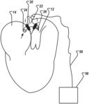 TREATING CONGESTIVE HEART FAILURE