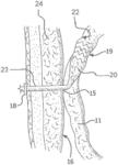 Medical device for use with a stoma