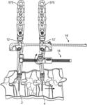 Spinal Trauma Correction and Fixation