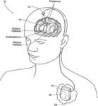 Non-regular electrical stimulation patterns for treating neurological disorders